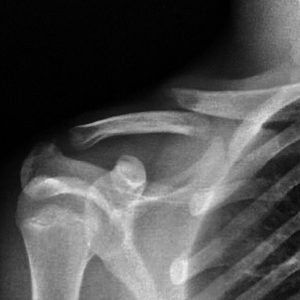 This is Augustine's broken shoulder